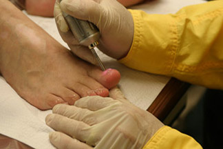 Fungal nail disease treatment in Oakville and Burlington Ontario